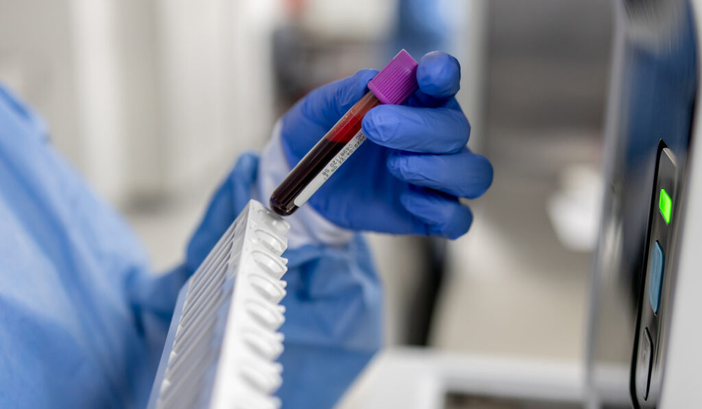 I’m an oncologist. Every man should know this about prostate cancer.