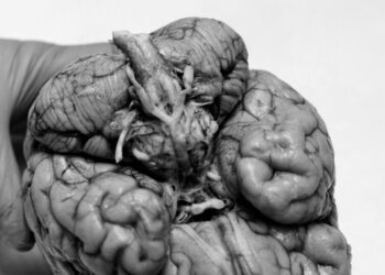 5 Takeaways on the Fallout From an Alarming C.T.E. Study