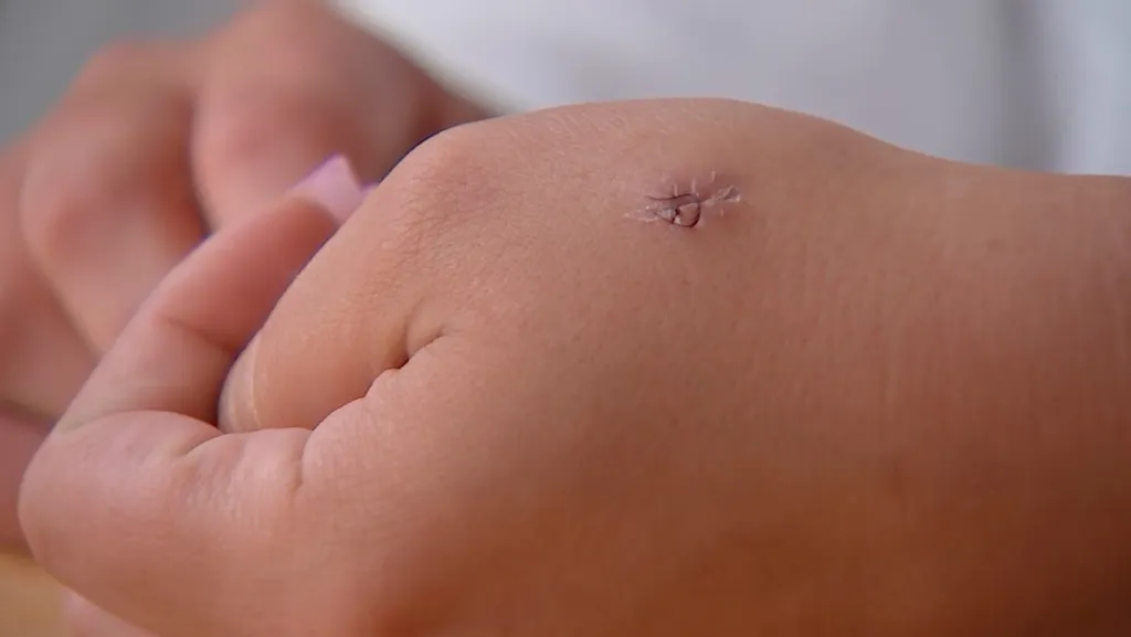 Close-up of a hand with a sutured wound.