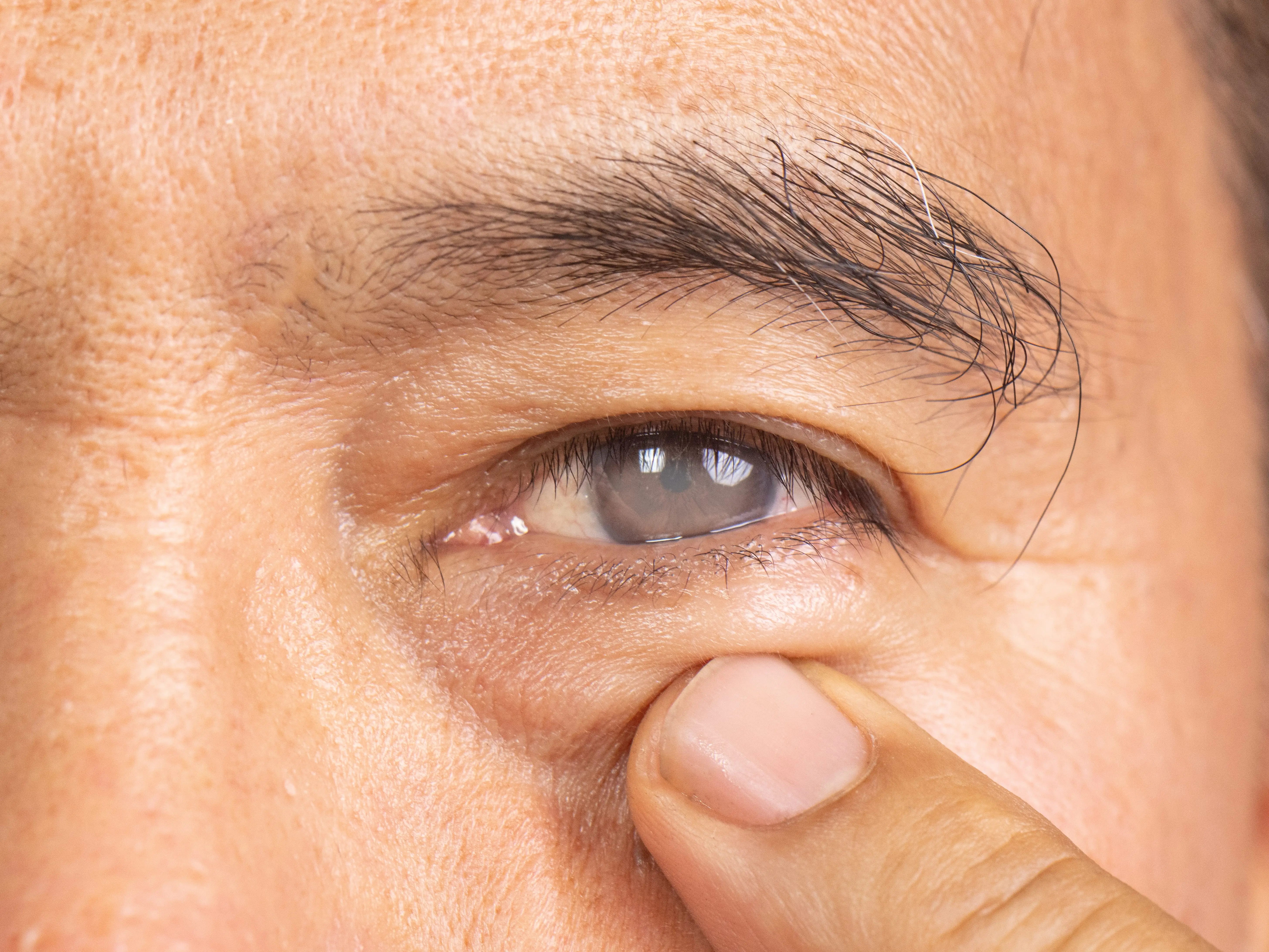 Man with cataracts