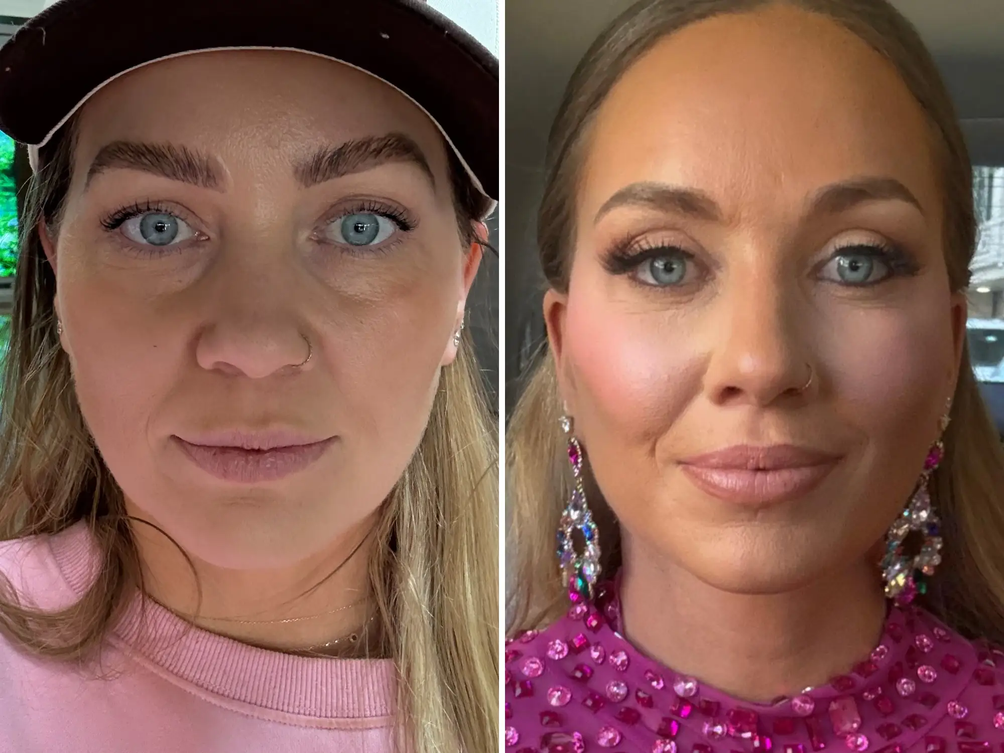 A woman before and after having a facelift.