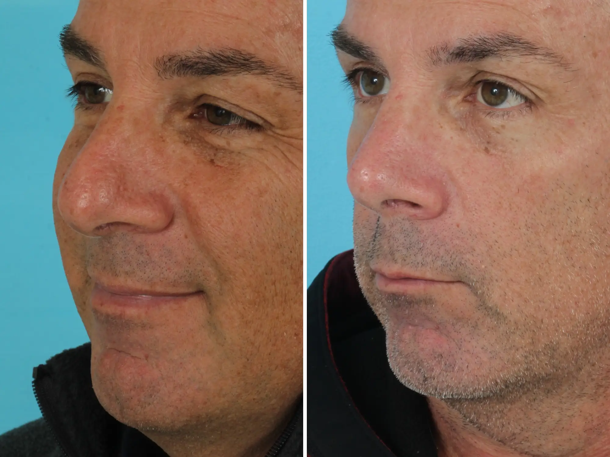 A middle-aged man before and after rhinoplasty.