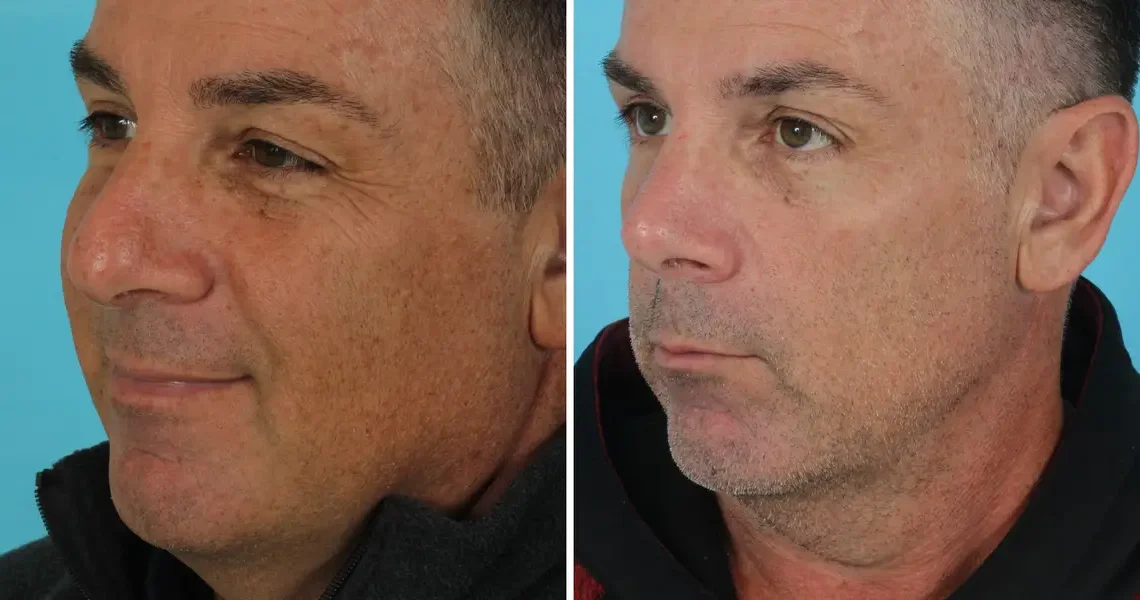 I’m a retired firefighter. I spent $14,000 on plastic surgery in my 50s, and I’m not ashamed.