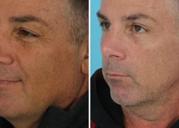 I’m a retired firefighter. I spent $14,000 on plastic surgery in my 50s, and I’m not ashamed.