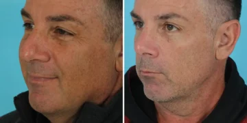 I’m a retired firefighter. I spent $14,000 on plastic surgery in my 50s, and I’m not ashamed.