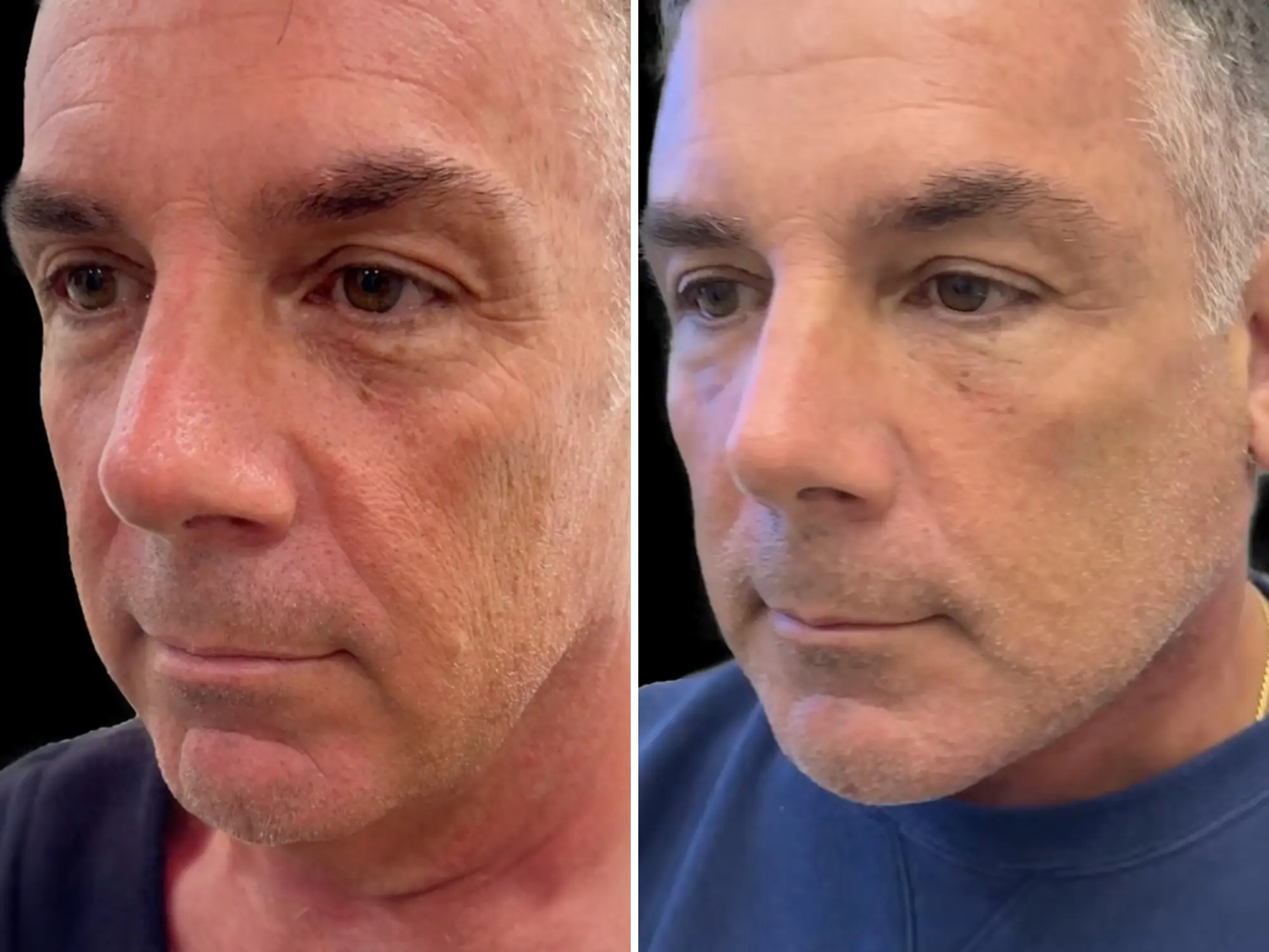 A middle-aged man before and after a neck lift and fat transfer.