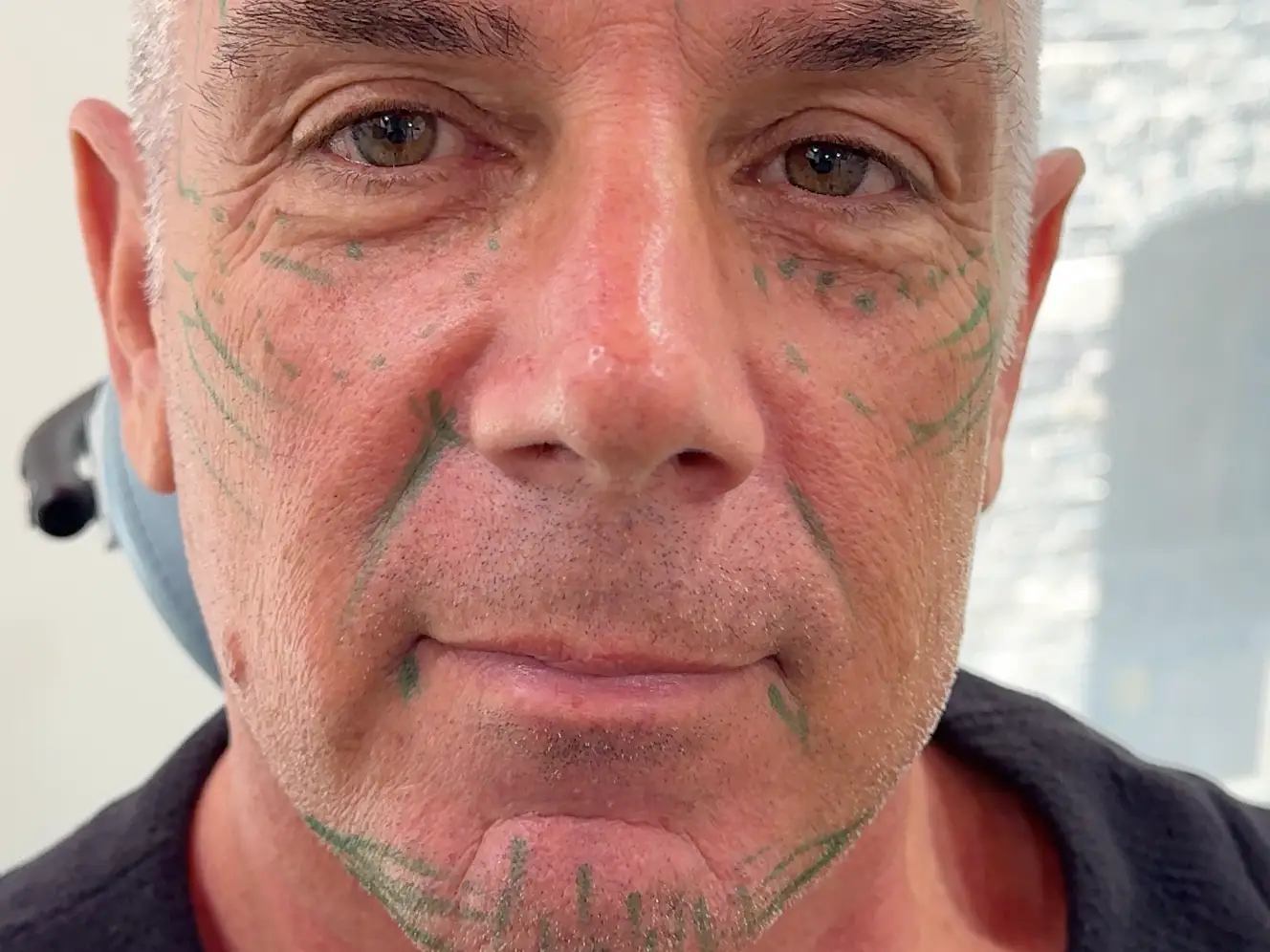 A middle-aged man marked up before plastic surgery.