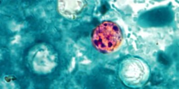 CDC Says Cyclospora Outbreak Has Reached 45 States