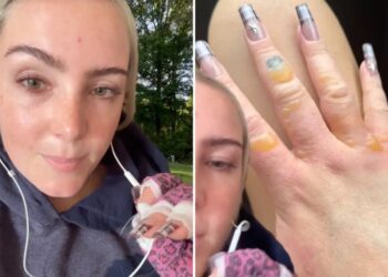 NYC woman warns against getting painful, blistering  ‘Margarita Burn’ by avoiding this common summer activity