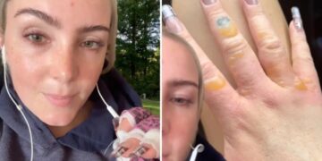 NYC woman warns against getting painful, blistering  ‘Margarita Burn’ by avoiding this common summer activity