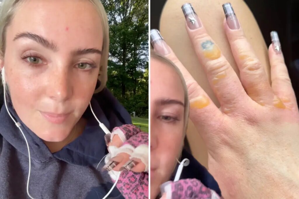 NYC woman warns against getting painful, blistering ‘Margarita Burn’ by avoiding this common summer activity