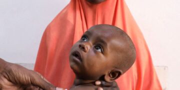 Severe malnutrition in Somalia is surging after U.S. cuts, aid groups say