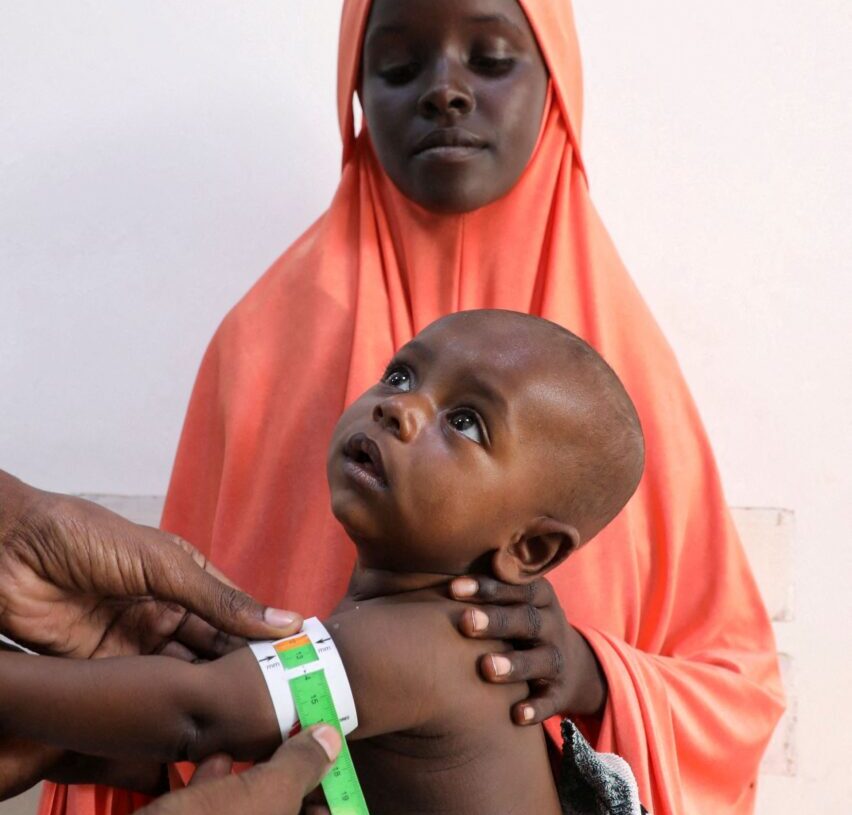 Severe malnutrition in Somalia is surging after U.S. cuts, aid groups say