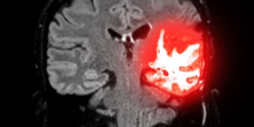 Nearly 1 in 4 NFL Players Who Died Had CTE, New Study Finds