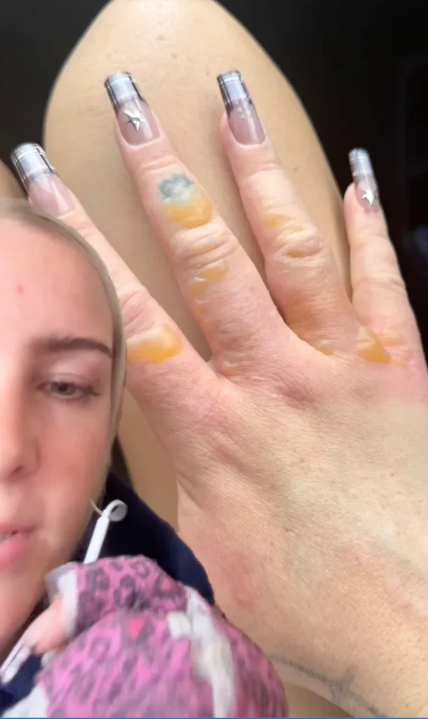 A person's hand with severe burns and blisters, partially obscured by their face.