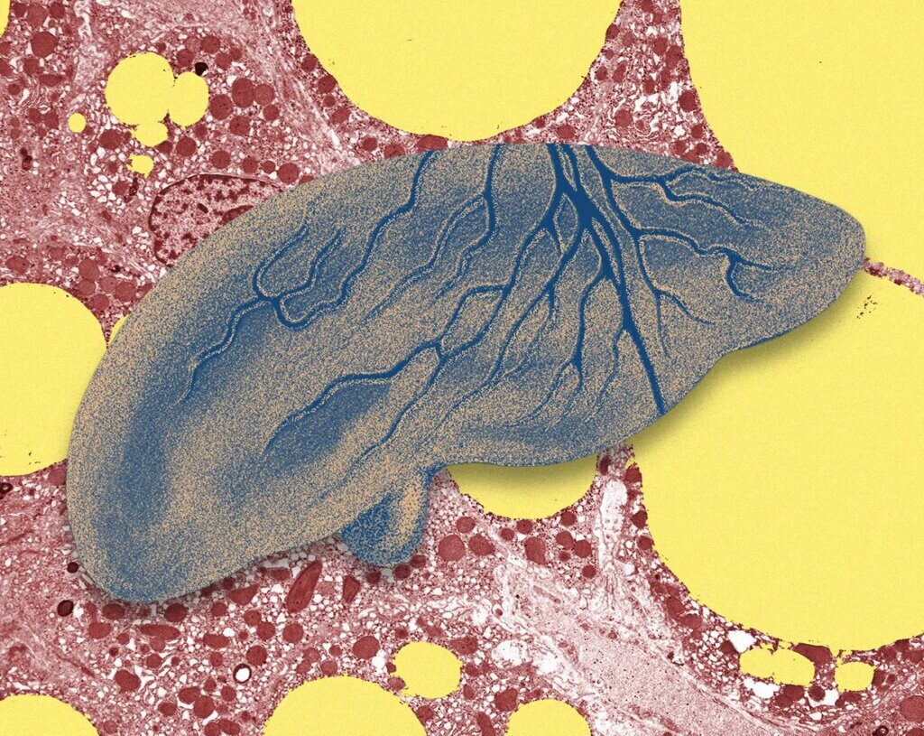 There’s a Fatty Liver Epidemic. AI Could Help Get Ahead of It