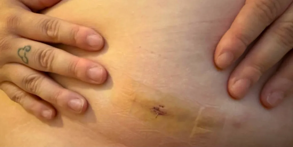 Amber Williams' organ removal scar.