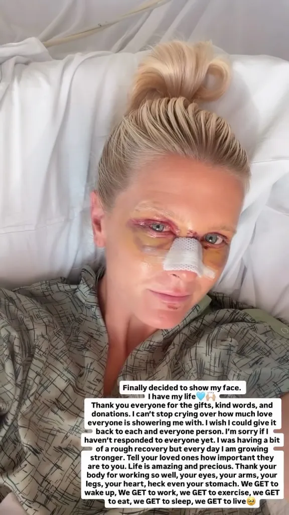 Johnni Bufkin Bernardo in a hospital bed with visible bruising around her eyes and bandages on her nose, after being injured in a car crash.