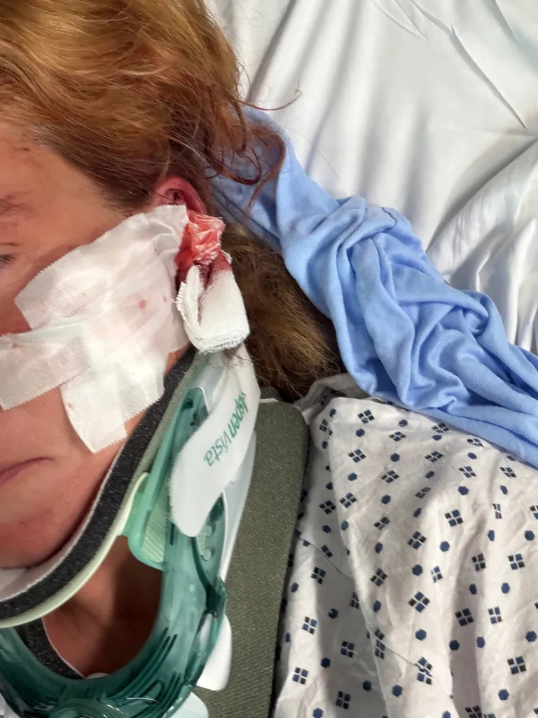 A woman with a neck brace and bandages covering her left eye and ear, which has blood on it, lying in a hospital bed.