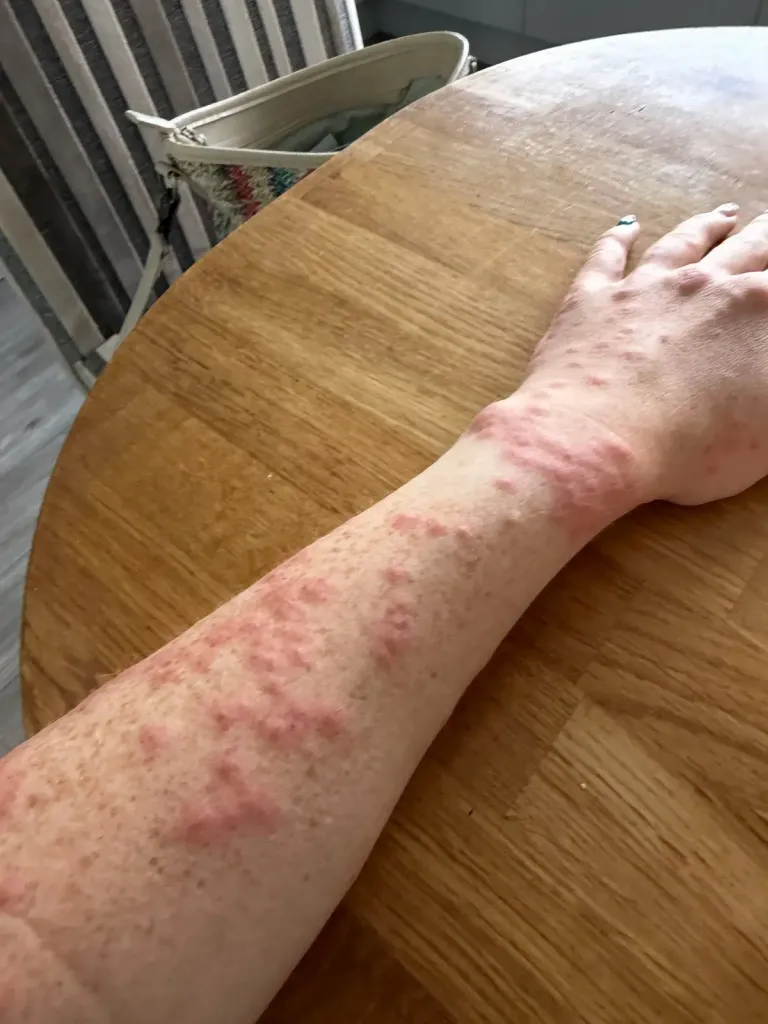 Hannah Stephenson, 31, suffered bites after staying at the Travelodge on Newmarket Road on July 26. Stephenson, of Bassingbourn, South Cambridgeshire, woke up the next day with itchy red lumps across her body and blood spots on the bedding.