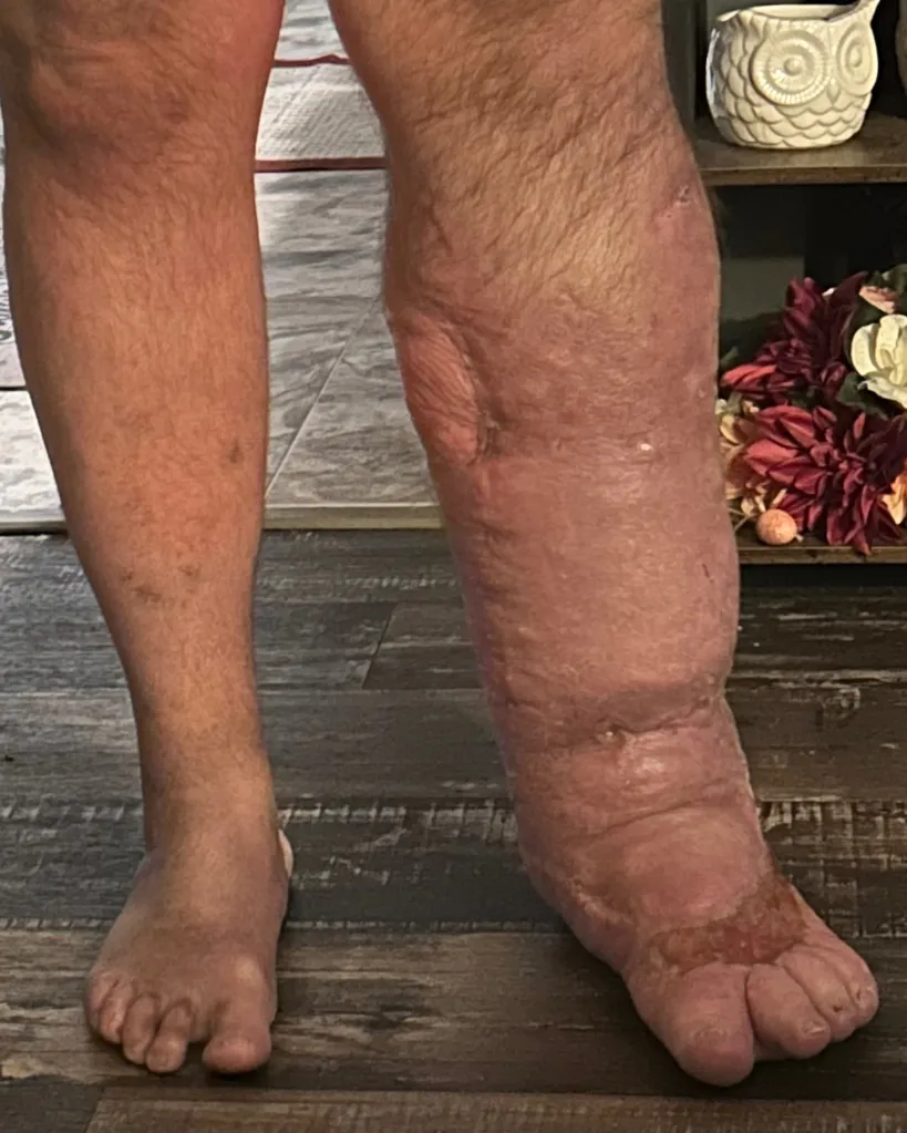 Image of Ben West's legs, with one leg appearing swollen and discolored due to a flesh-eating bacteria infection.