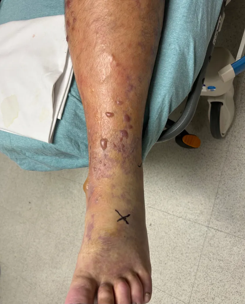 The leg and foot of Ben West covered in lesions caused by Vibrio vulnificus.