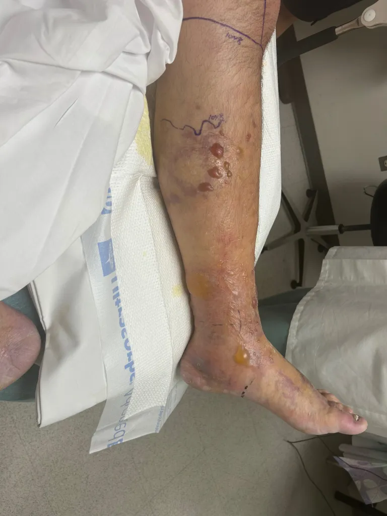 A leg and foot showing extreme swelling and blistering from Vibrio vulnificus.
