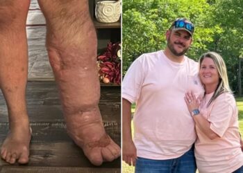 Horrifying reality of flesh-eating bacteria that caused Florida man’s leg to swell to 8 times its size