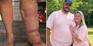 Horrifying reality of flesh-eating bacteria that caused Florida man’s leg to swell to 8 times its size