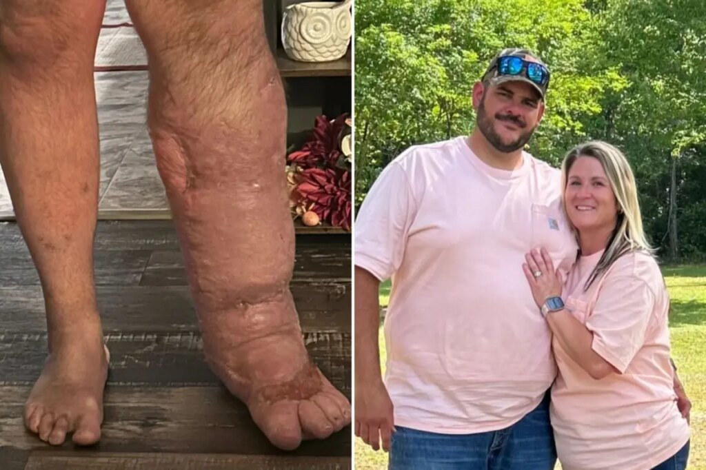 Horrifying reality of flesh-eating bacteria that caused Florida man’s leg to swell to 8 times its size