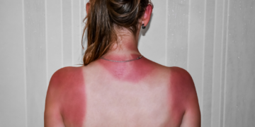 One Bad Sunburn Can Change Your Health for Life, Dermatologists Say