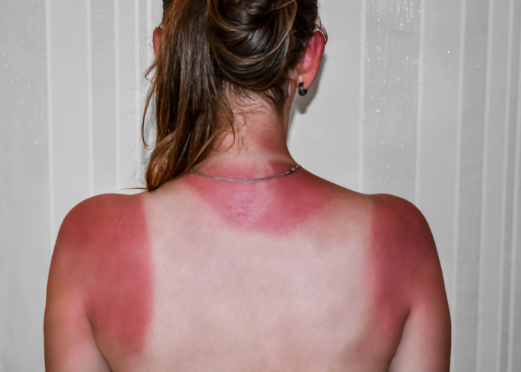 One Bad Sunburn Can Change Your Health for Life, Dermatologists Say
