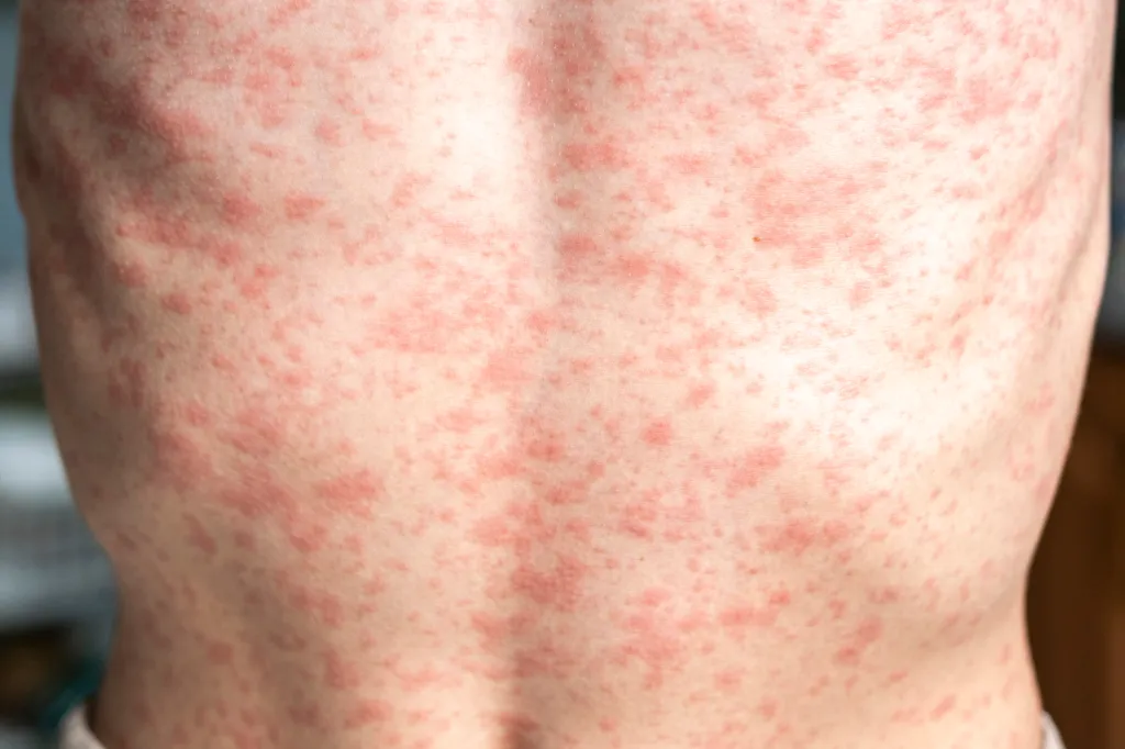 A person's body covered in a measles rash.