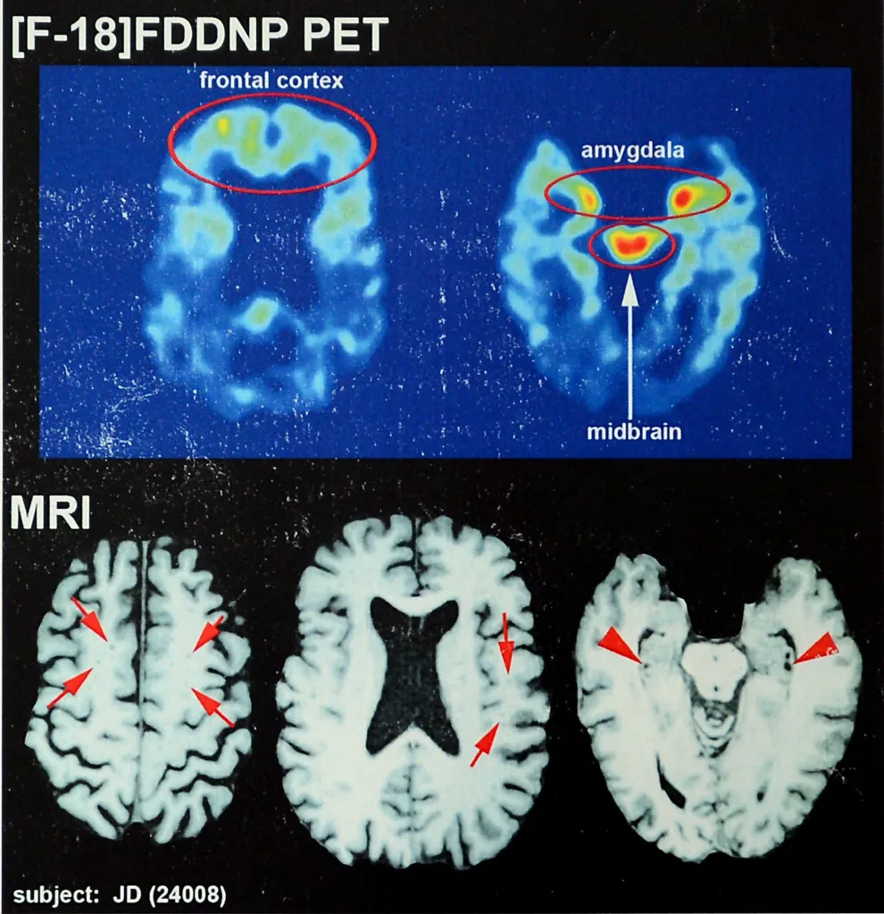 Brain scans showing CTE in the frontal cortex, amygdala, and midbrain.