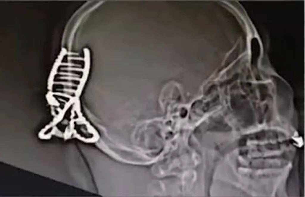 X-ray of a skull with a hair clip lodged in it.