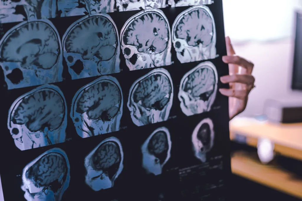 MRI film showing sagittal views of the brain, likely indicating frontal lobe atrophy, held by a person.