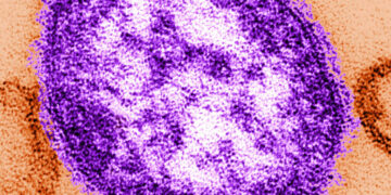 Six-Week-Old Infant Died From Measles, Lancaster Coroner Says