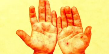 The CDC Is Now Denying That Specific Children Died From Measles, in a Scandal Potentially Beyond Anything in Its History
