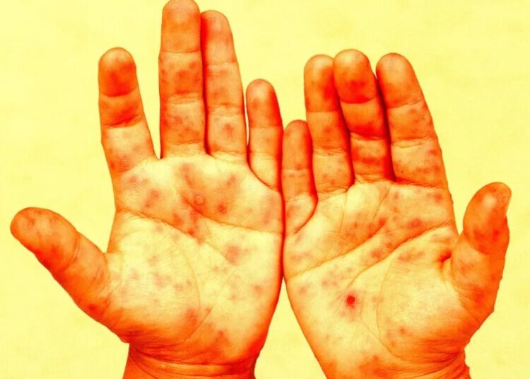 The CDC Is Now Denying That Specific Children Died From Measles, in a Scandal Potentially Beyond Anything in Its History