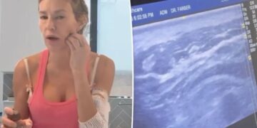 Brandi Glanville saw ‘something alive’ and ‘moving’ in her face in horrifying ultrasound