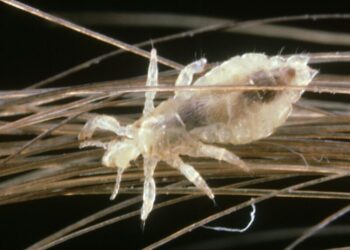 It’s Head Lice Season. Here’s What to Know