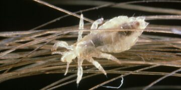 It’s Head Lice Season. Here’s What to Know