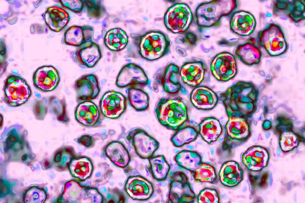 Pennsylvania woman dies of measles-related complications, local coroner says