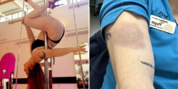 Woman, 28, diagnosed with leukemia after brushing off large, unexplained bruises as pole dancing injuries