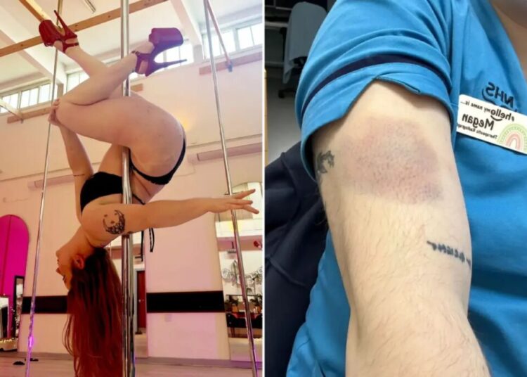Woman, 28, diagnosed with leukemia after brushing off large, unexplained bruises as pole dancing injuries