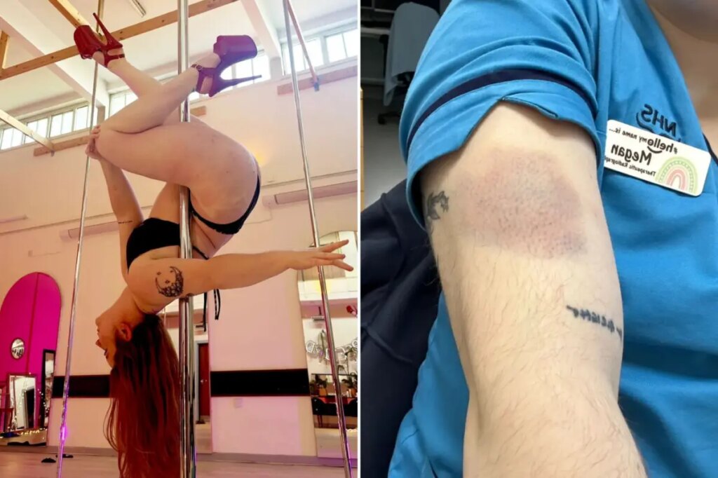 Woman, 28, diagnosed with leukemia after brushing off large, unexplained bruises as pole dancing injuries