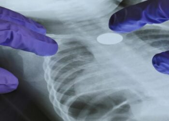 A Genetic Mutation May Help Explain Lung Cancer in Nonsmokers