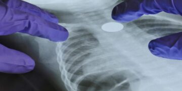A Genetic Mutation May Help Explain Lung Cancer in Nonsmokers