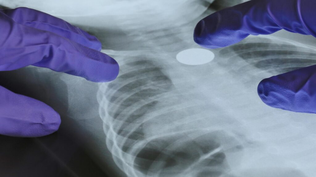 A Genetic Mutation May Help Explain Lung Cancer in Nonsmokers