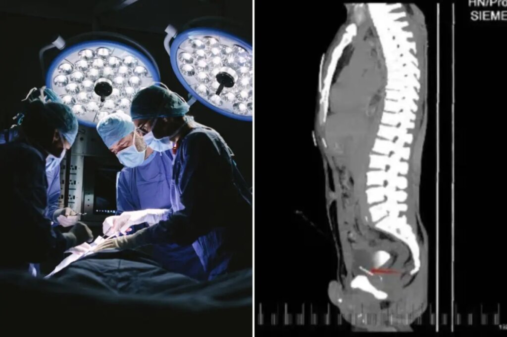 Doctors find shocking ‘foreign bodies’ inside a man’s chest, pelvis, bladder — and penis